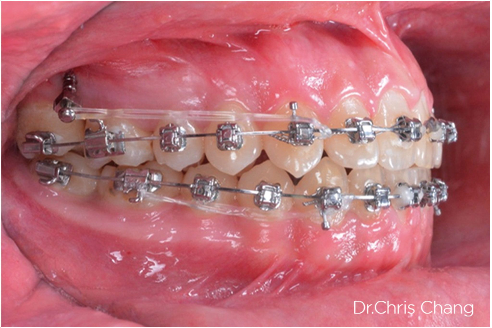 Caso Clínico con Microtornillos OBS con brackets metalicos por el Doctor Chris Chang