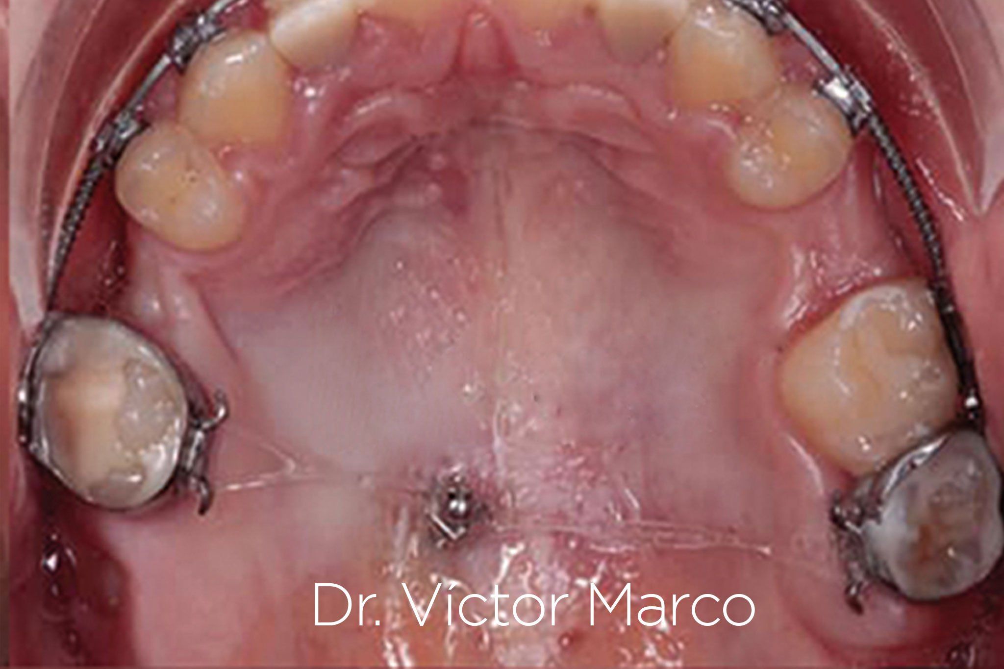 Caso Clínico con Microtornillos OBS con brackets metalicos por el Doctor Victor Marco